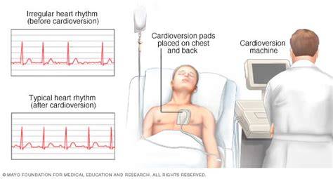 What To Expect After Electrical Cardioversion