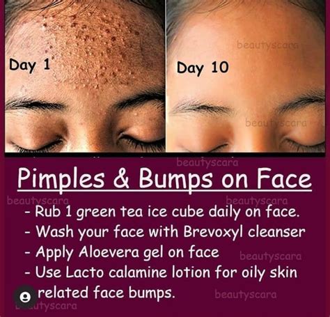 Simple Beauty Tips To Clear Your Face Pimples Effectively