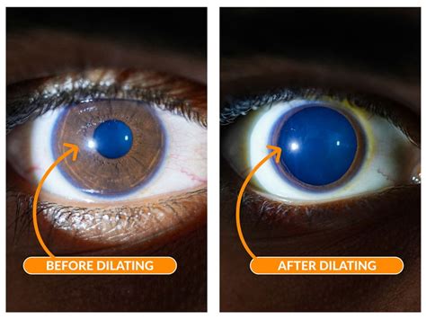 Does A Concussion Make Your Pupils Dilate