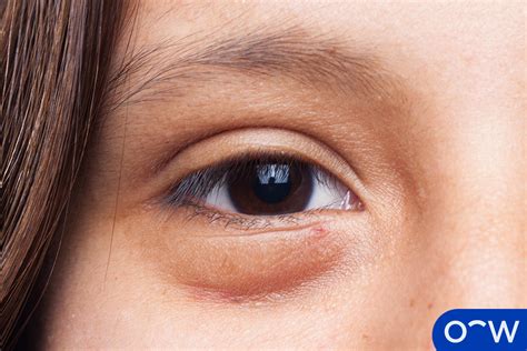 5 Effective Home Remedies To Unswell Eyes Fast