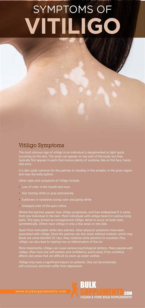 Recognizing The Primary Symptoms Of Vitiligo Early